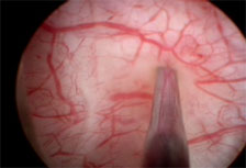 Botox injection photo