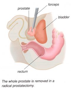 prostatectomy graphic