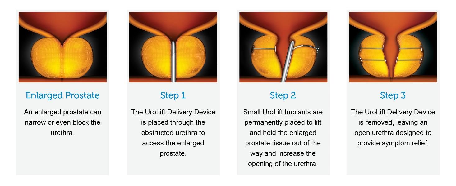 UroLift® System Treatment - Virginia Urology